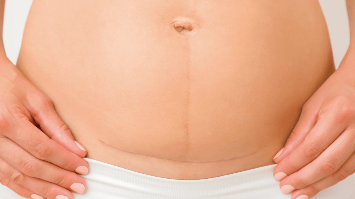 ¿Cómo cuidar una césarea?