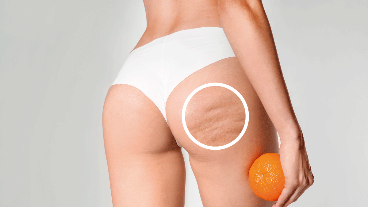 Tips básicos para combatir la piel de naranja