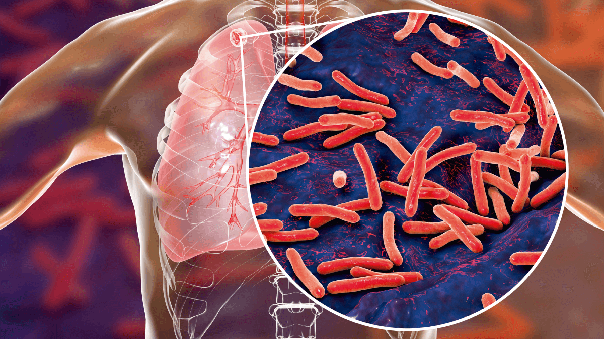 Tuberculosis - Síntomas y cuidados