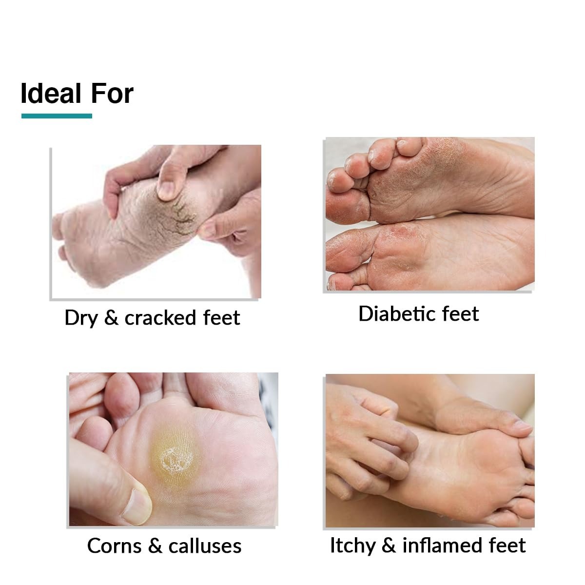 Fixderma Foobetik Cream, Foot cream, Foot care for diabetic, For Dry & Cracked Feet, Moisturizes & Soothes Feet, Heel Repair, For Calloused, or Chapped Skin, Paraben Free - 100g