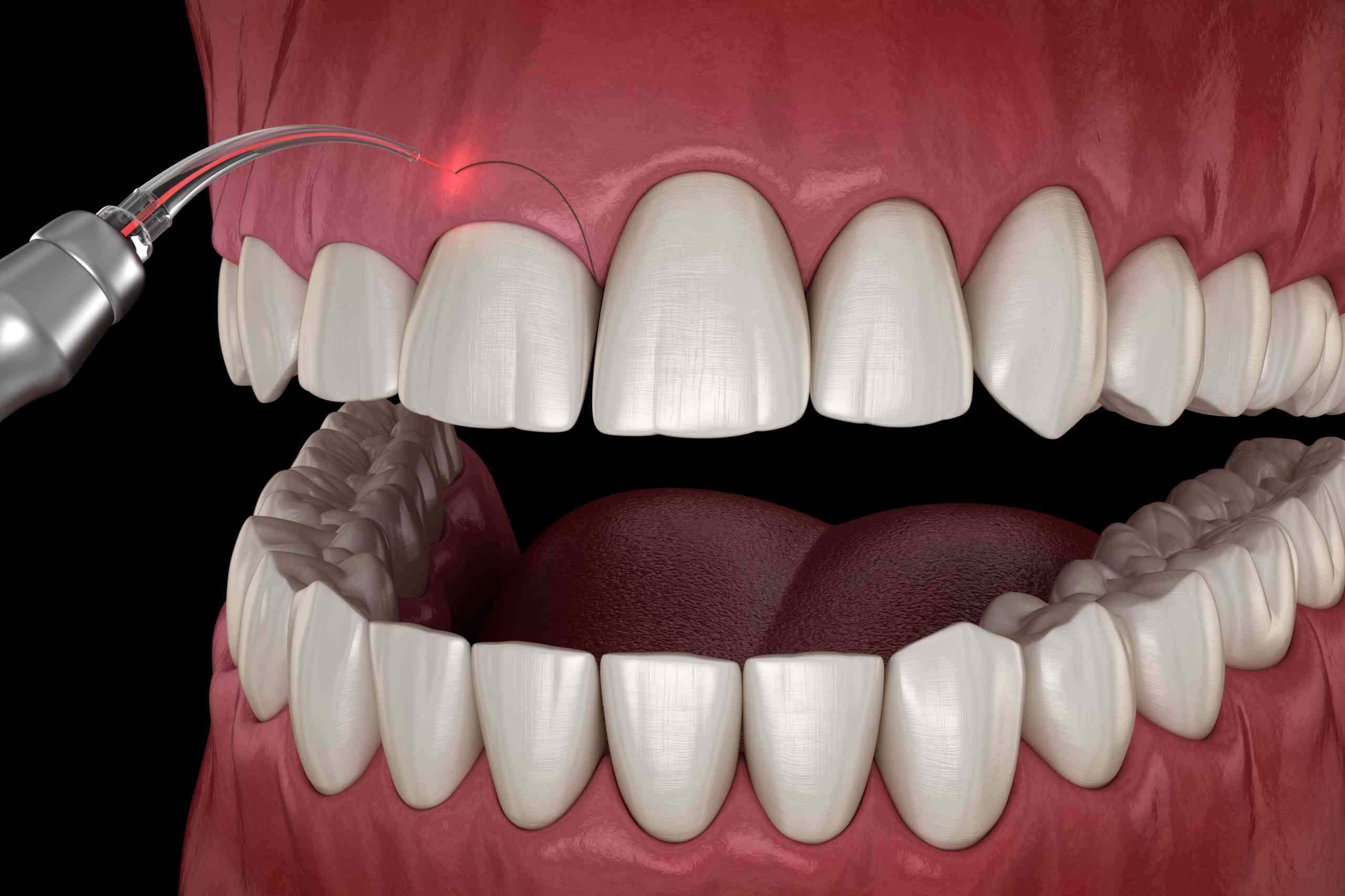 Gingivectomía: lo que debe saber sobre la cirugía