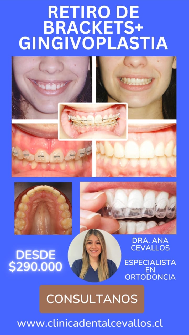 Retiro de Brackets + Gingivoplastia