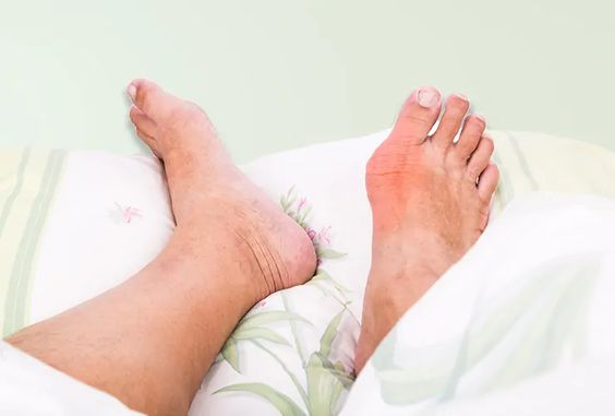 Gout Treatment Tips
