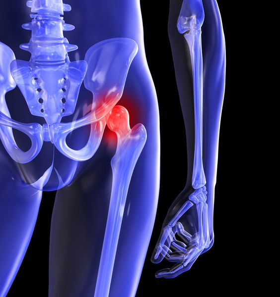 Hip Resurfacing: Benefits and Risks