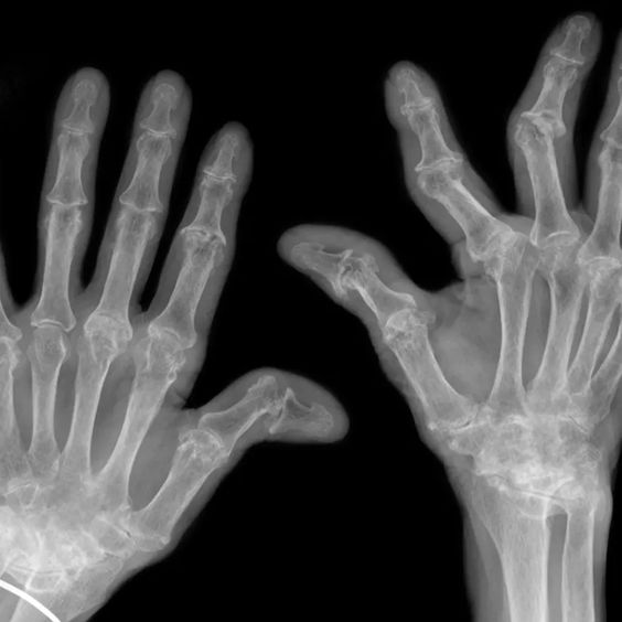 Managing Rheumatoid Arthritis Symptoms