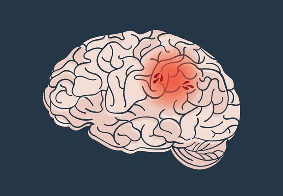 Stroke: What It Is, Causes, Symptoms, Treatment and Types