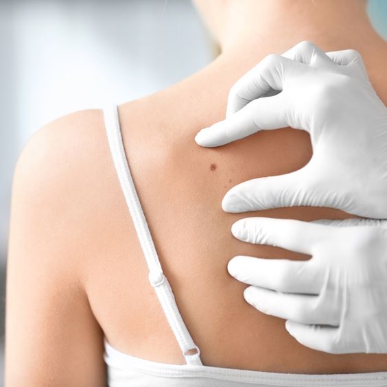 Treating Skin Cancer: Surgical Options