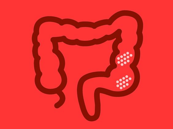 Treating Ulcerative Colitis