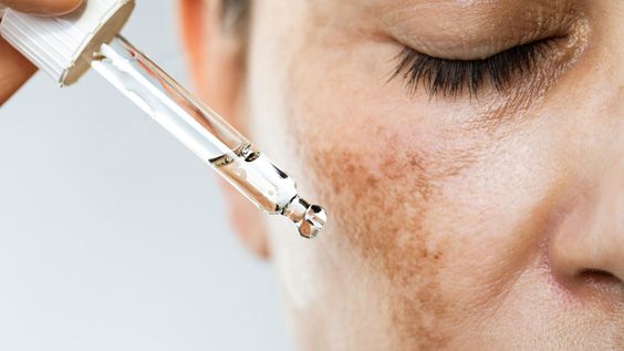 Understanding Sun-Induced Hyperpigmentation