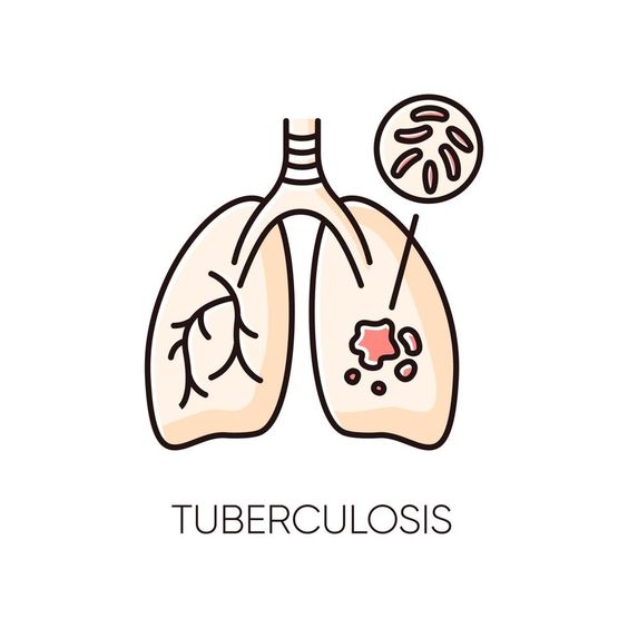 Understanding Tuberculosis