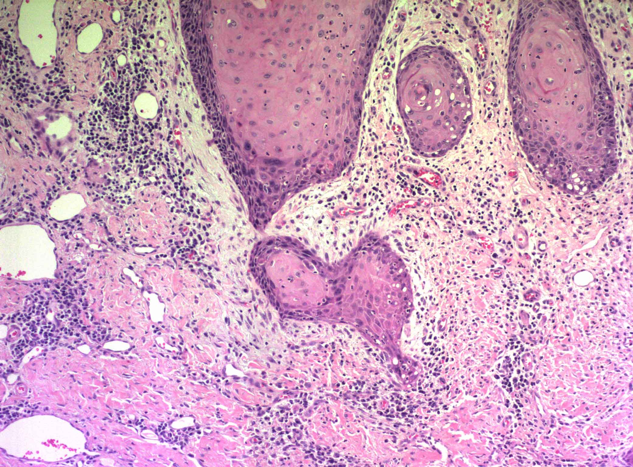 The Histopathology Of Vulvar Neoplasia SKILLMD