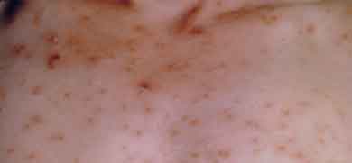 Photo of chickenpox rash on the back of a person’s shoulders.