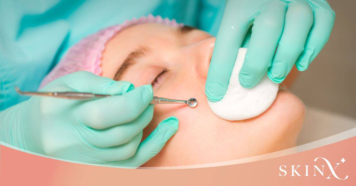 การกดสิว (Comedone extraction)