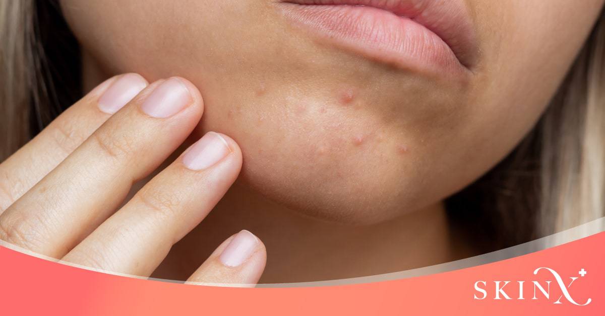 สิวที่คางเกิดจากอะไร