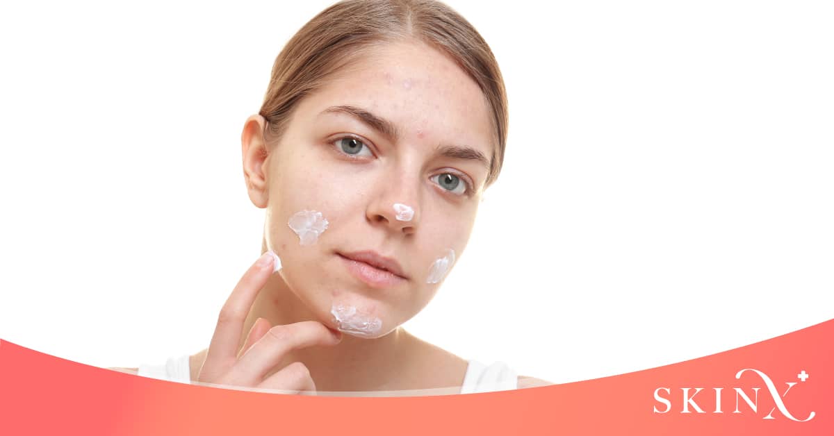 วิธีการรักษาสิวที่คาง สิวใต้คาง