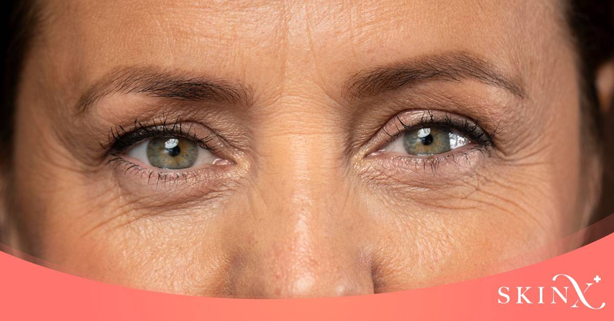 ถุงใต้ตา