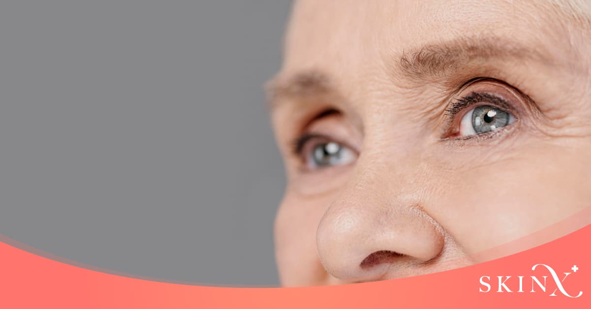 ริ้วรอยใต้ตา