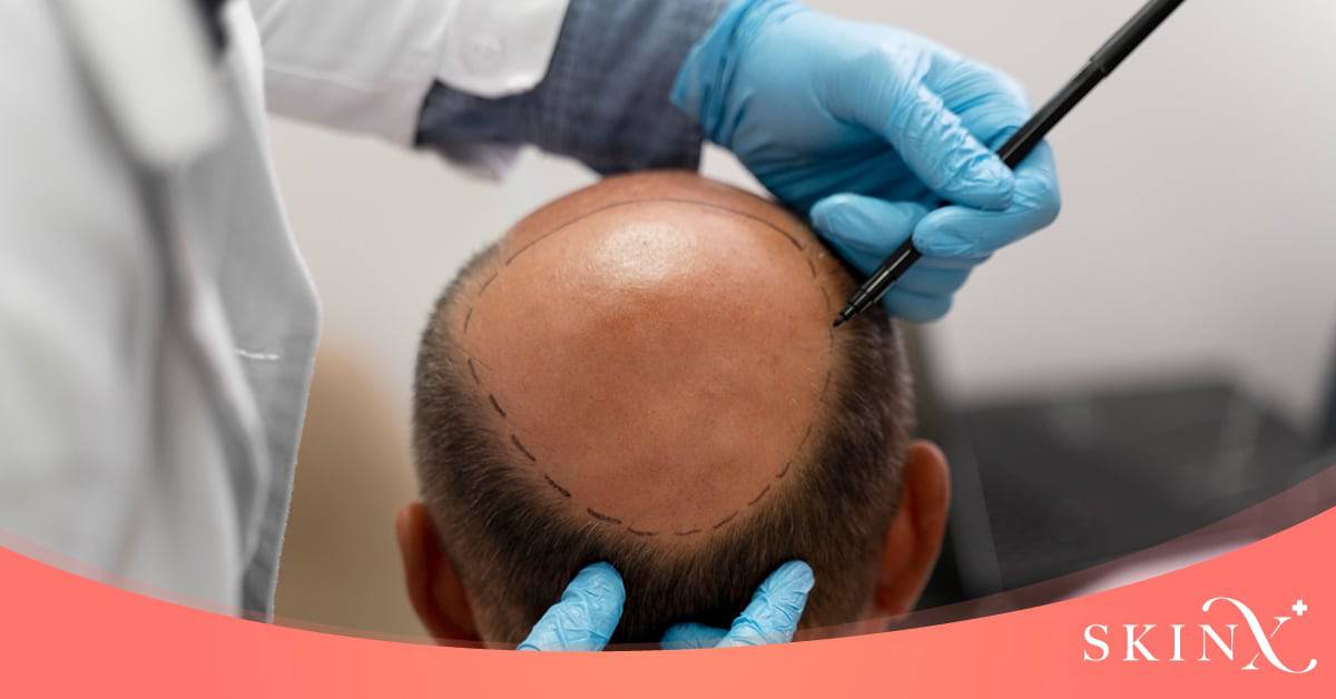 วิธีรักษาผมร่วง