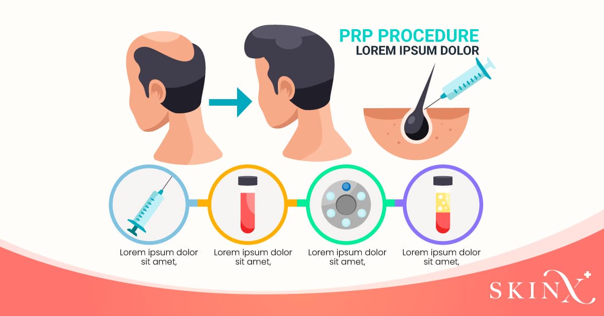 การทำ PRP ผม