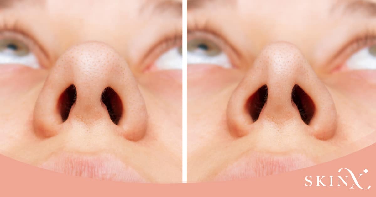 ฉีดฟิลเลอร์จมูก