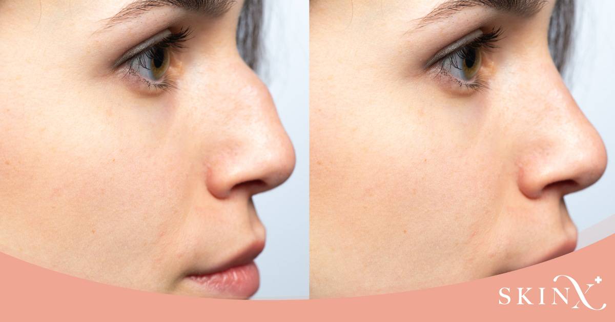 ฉีดฟิลเลอร์แก้ฮัมพ์