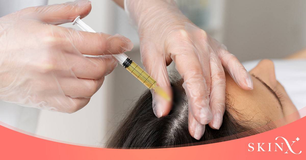 ทำ PRP ผม ต้องทำกี่ครั้ง