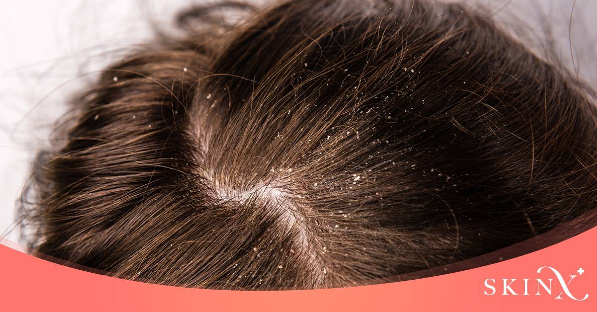 วิธีรักษาเชื้อราบนหนังศีรษะ