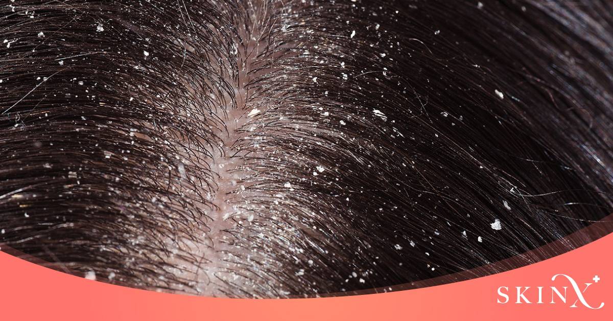 สาเหตุของเชื้อราบนหนังศีรษะ