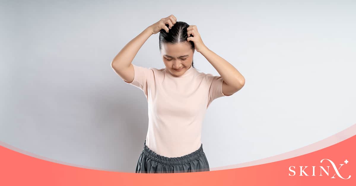 เชื้อราบนหนังศีรษะ