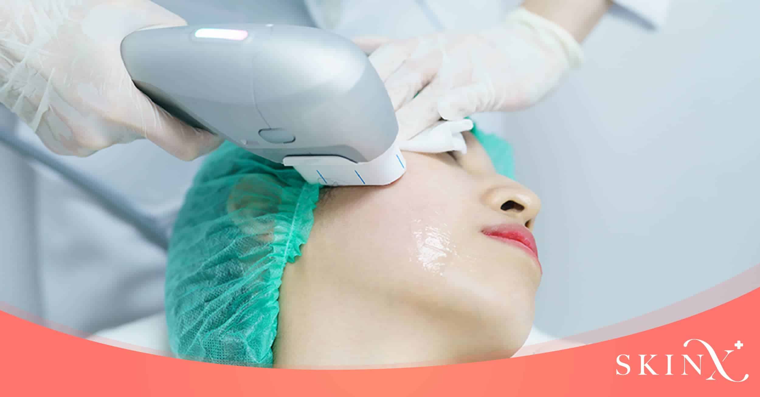 Hifu กี่วันเห็นผล