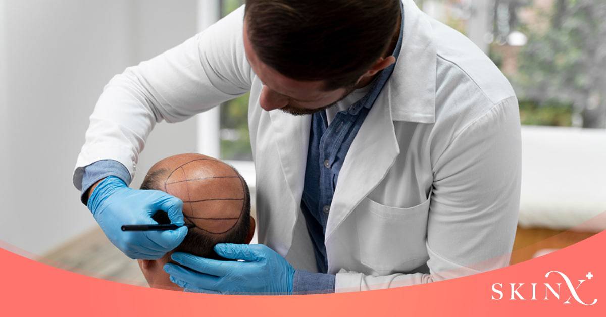 วิธีปลูกผม