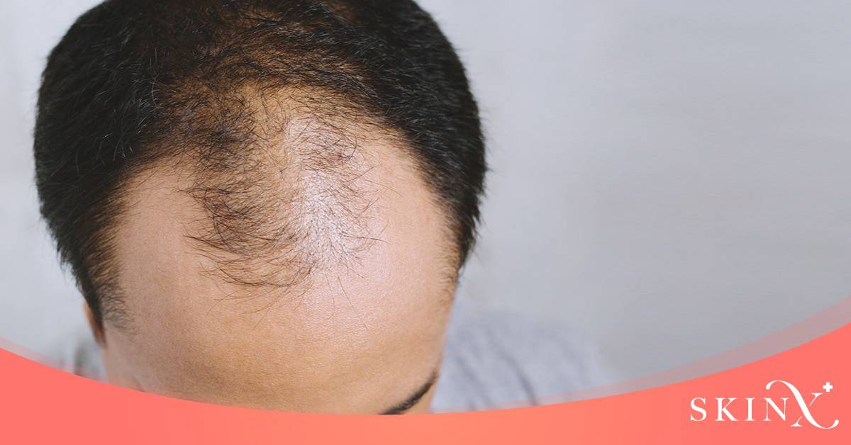 เซรั่มปลูกผม