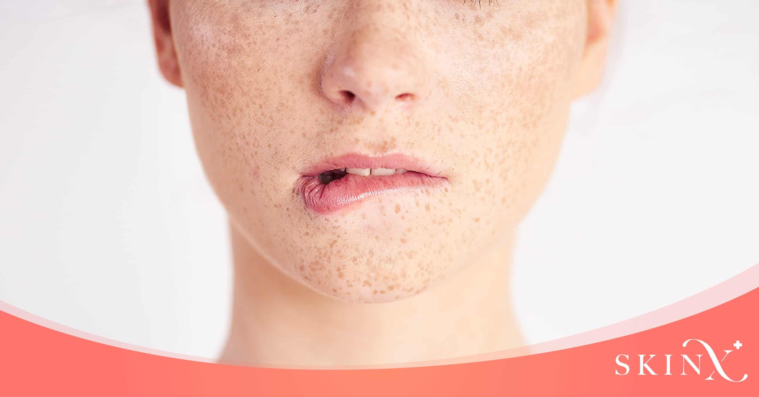 q switch laser ช่วยเรื่องอะไร