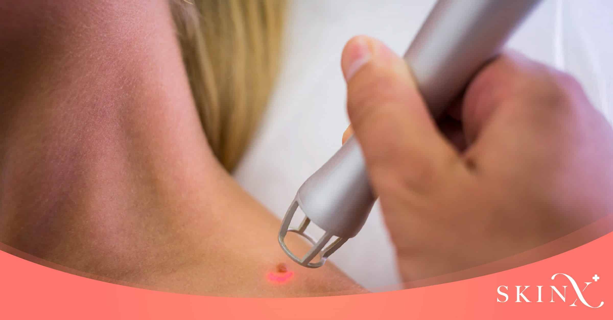 เลเซอร์กระมีกี่แบบ?