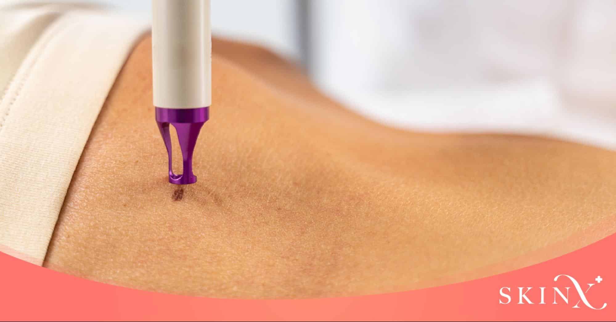 ขั้นตอนเลเซอร์ไฝ