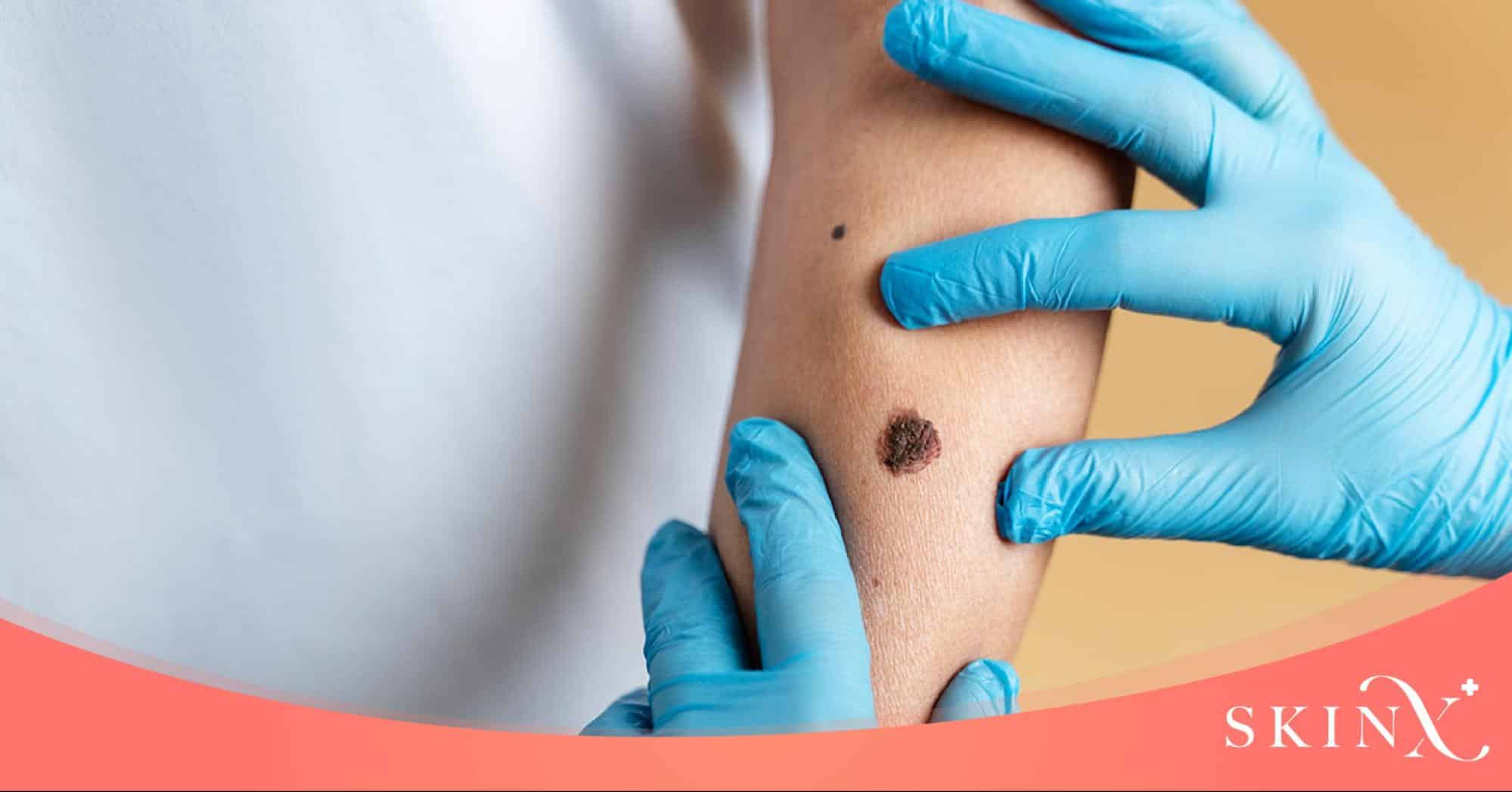 ข้อปฏิบัติก่อนการเลเซอร์ไฝ