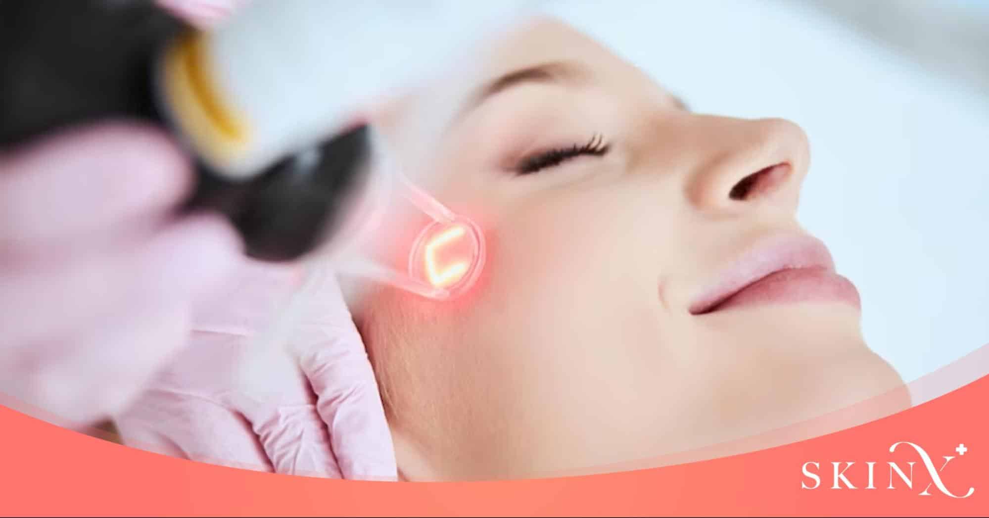 ทํา Vbeam laser ที่ไหนดี