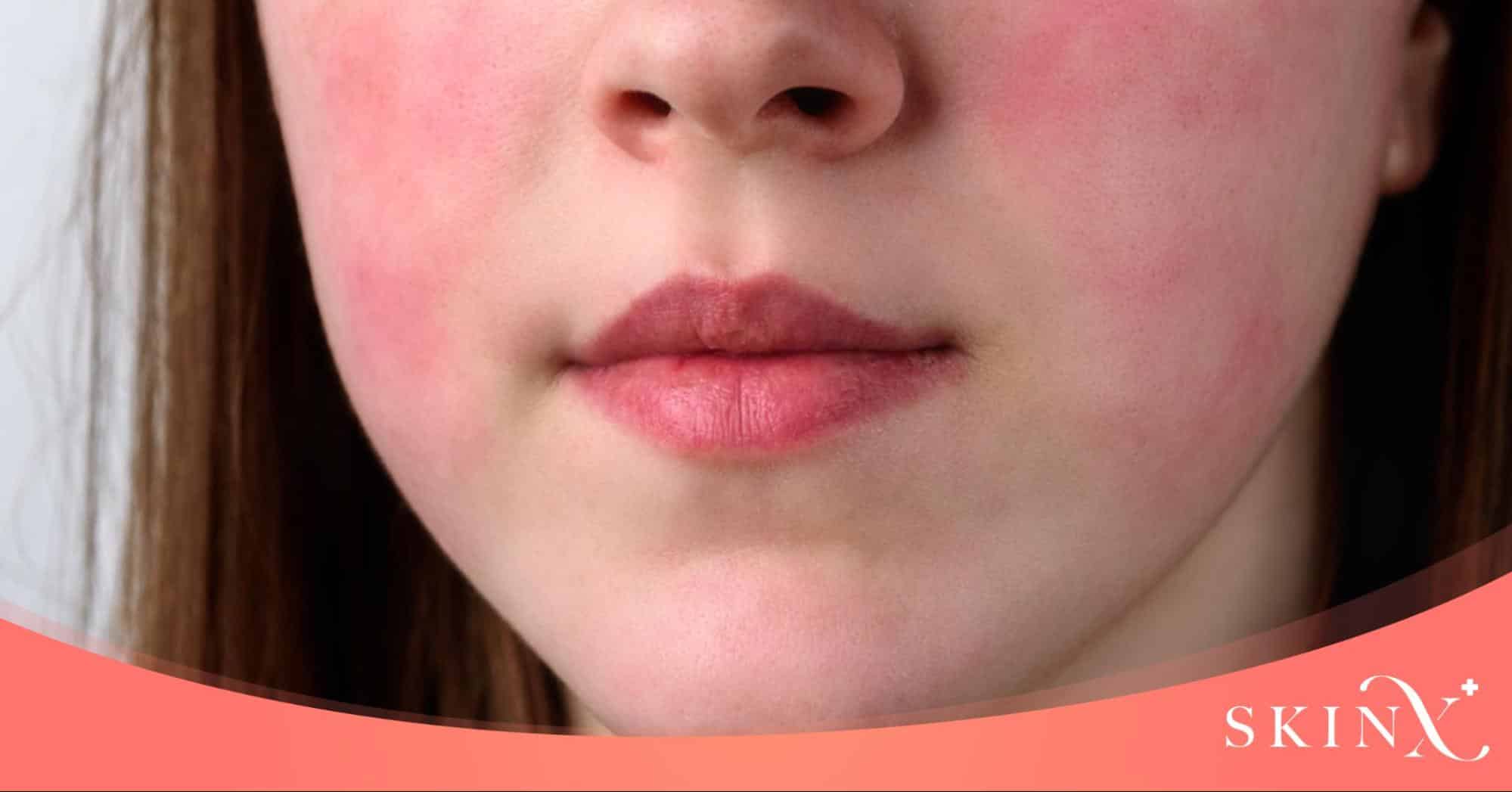 Pico laser ผลข้างเคียง