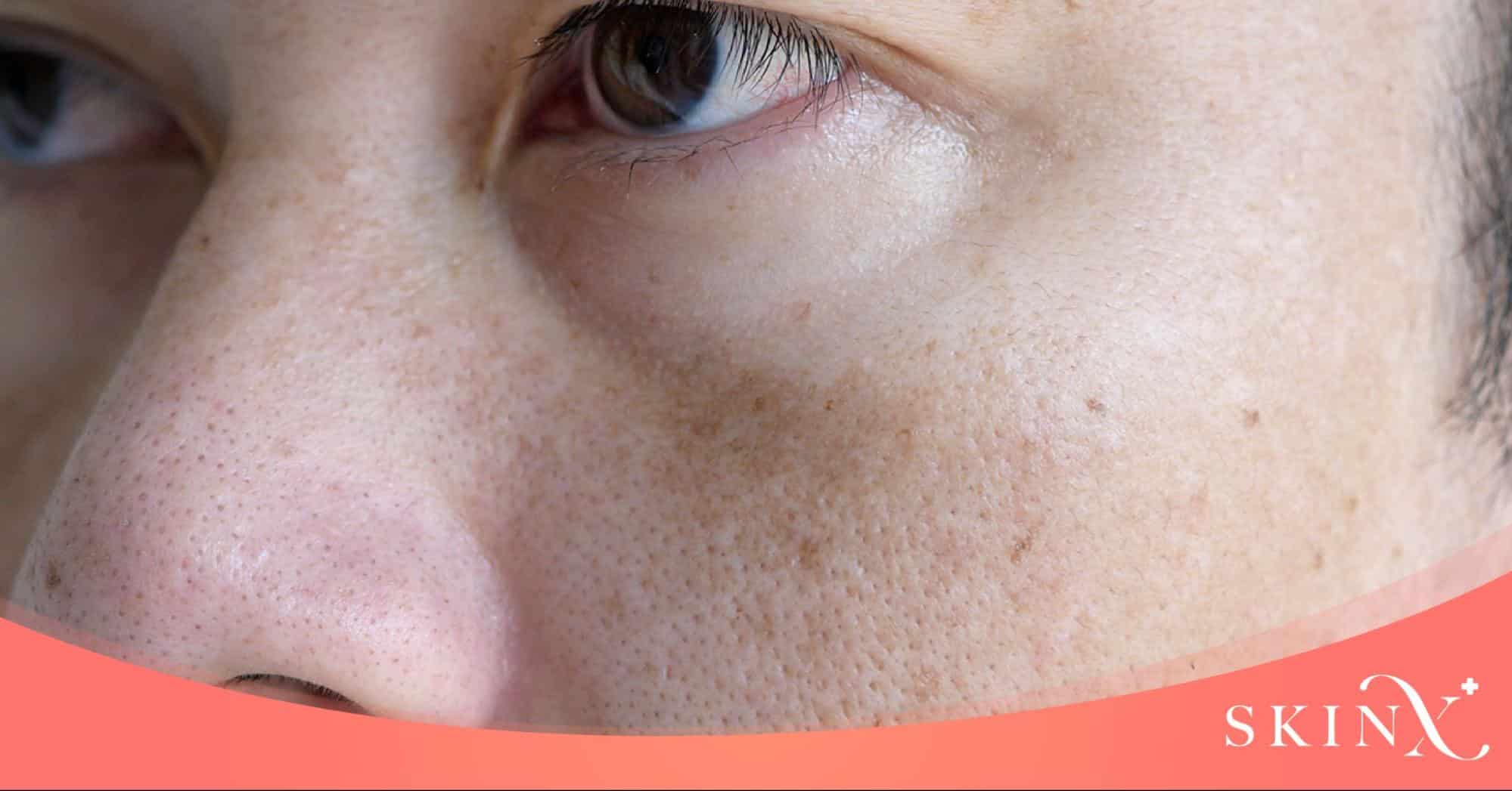 ผลข้างเคียงจากเลเซอร์ ฝ้า