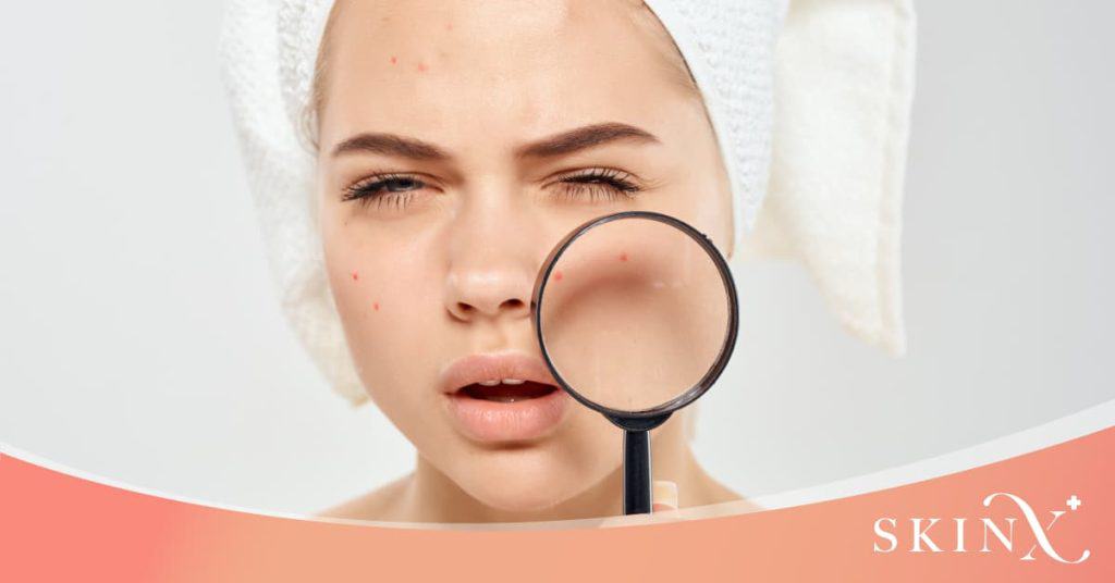 ลด สิว อักเสบ