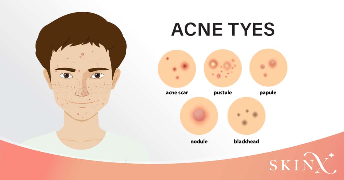 ประเภทของสิวอักเสบ