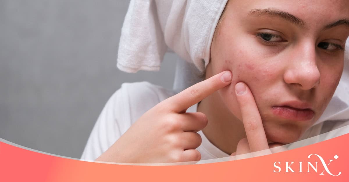 ประเภทของสิวที่แก้ม