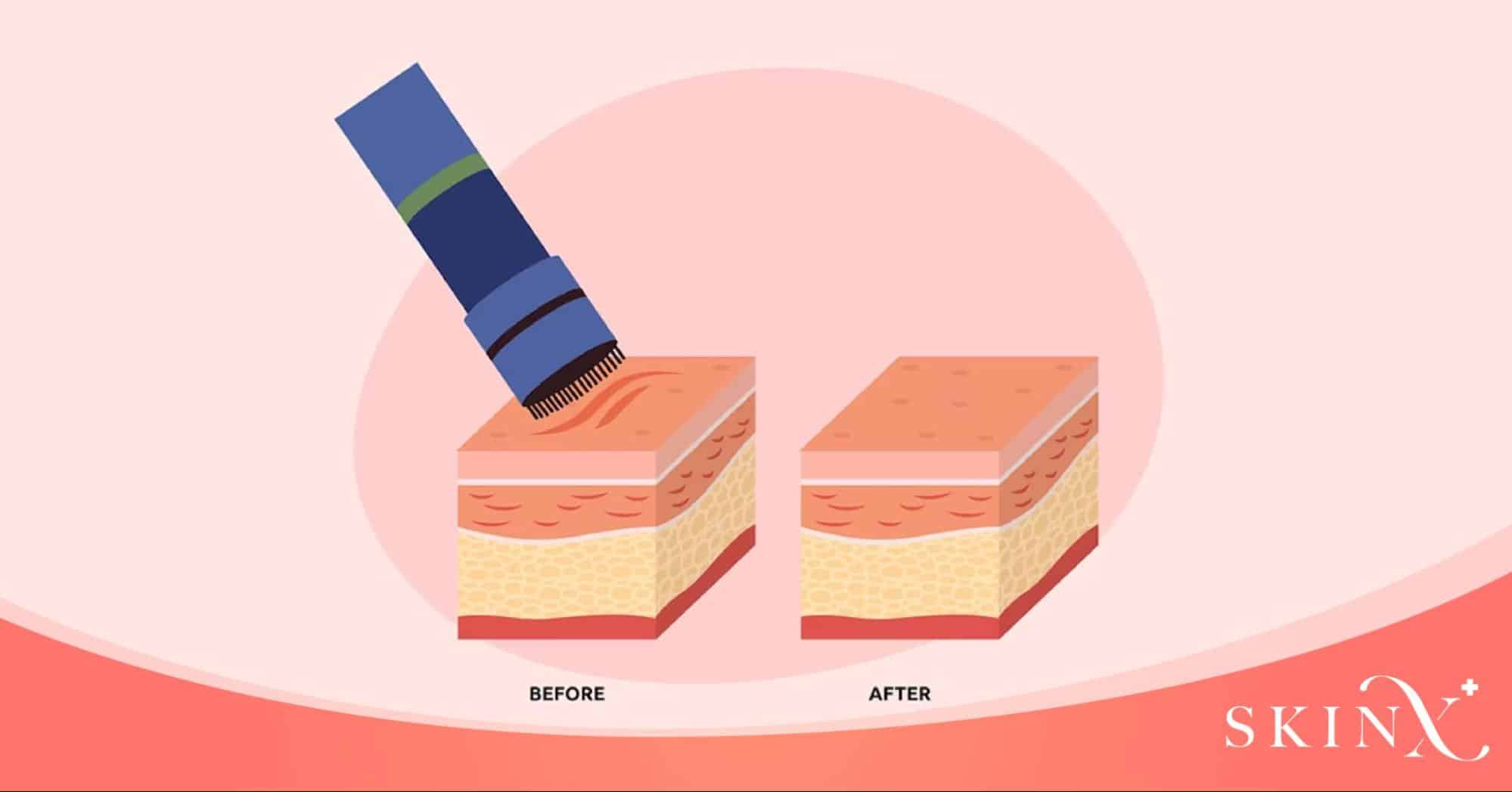 Fractional RF คือ