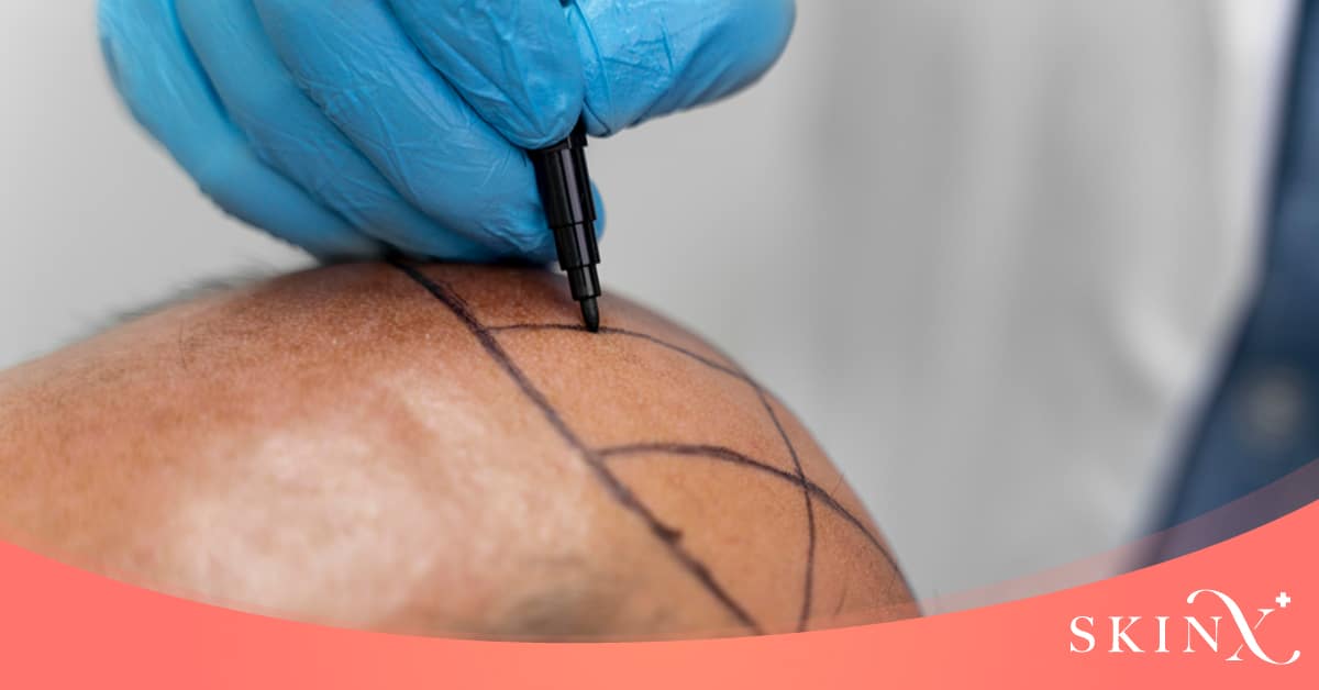 ปลูกผมถาวร