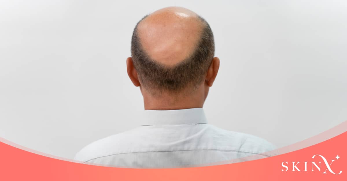 ปลูกผมเหมาะกับใครบ้าง