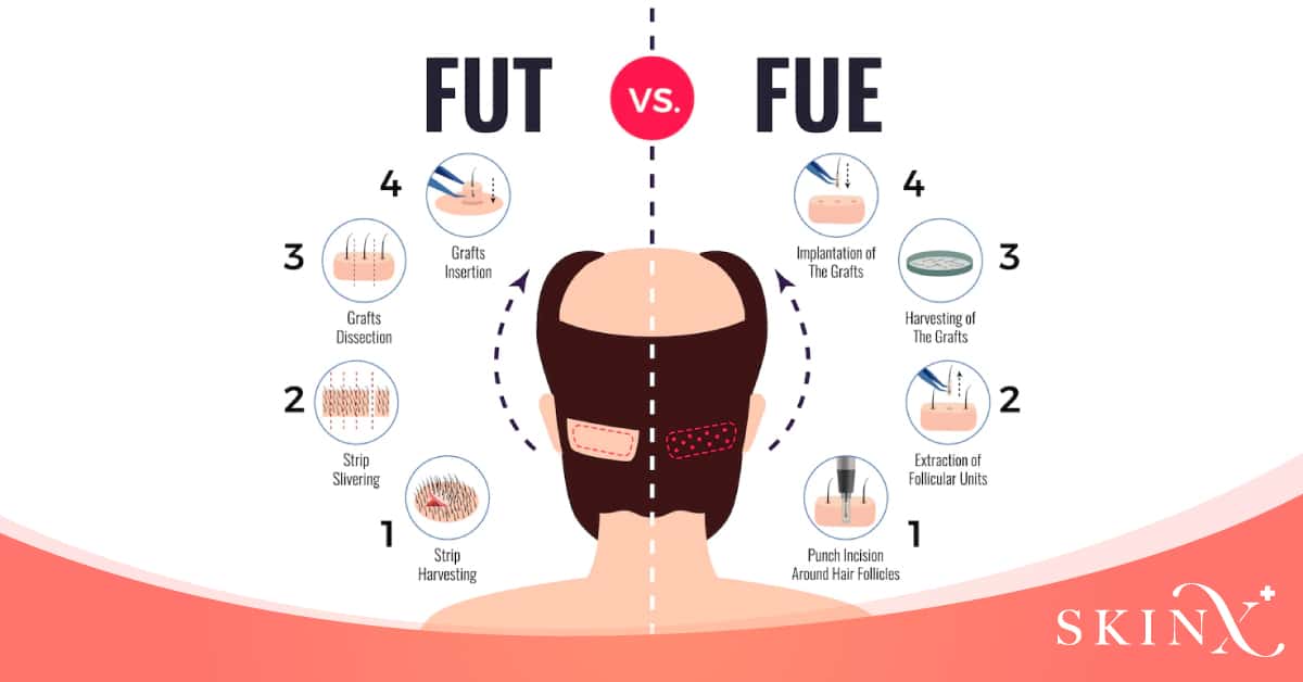 เทคนิคการปลูกผม FUT FUE