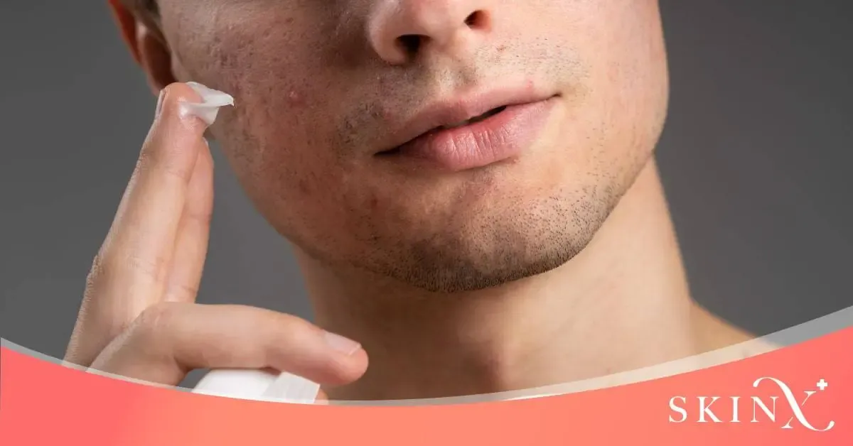 หน้าสิว