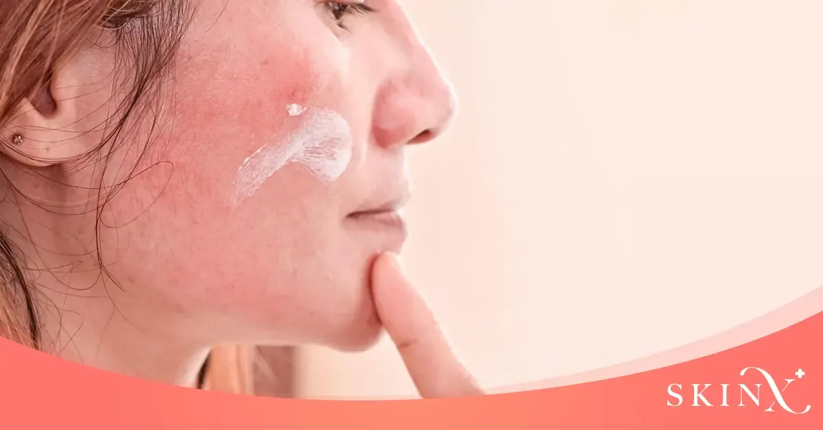 สิวแพ้ครีม รักษายังไง