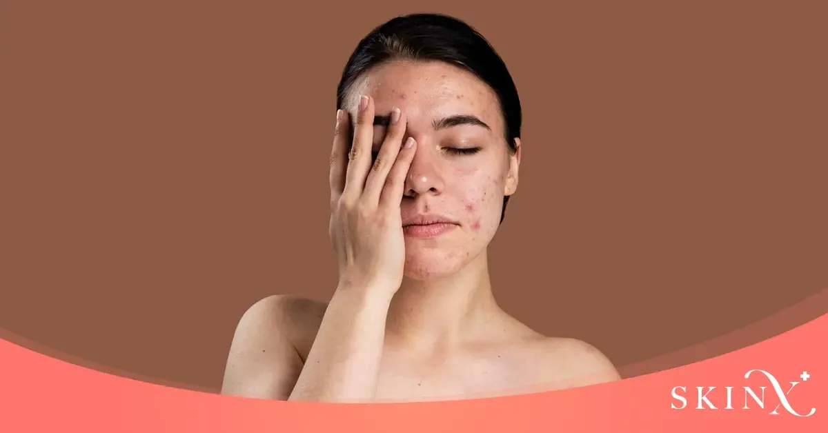 ฉีดสิวอักเสบ