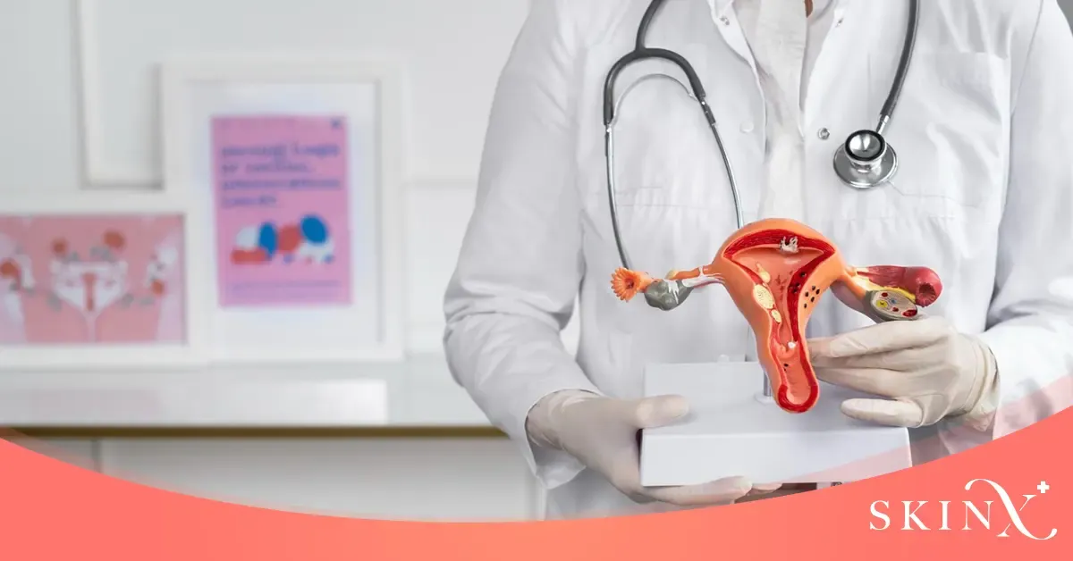 รักษา PCOS